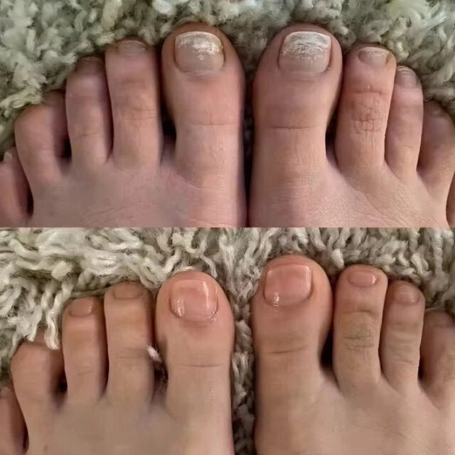 🌿¡Tratatamiento intensivo! Aureva Antihongos Pro Repair Oil Maxâ„¢  - Adiós a los hongos en solo 7 dÃas (Copy)