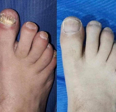 🌿¡Tratatamiento intensivo! Aureva Antihongos Pro Repair Oil Maxâ„¢  - Adiós a los hongos en solo 7 dÃas (Copy)