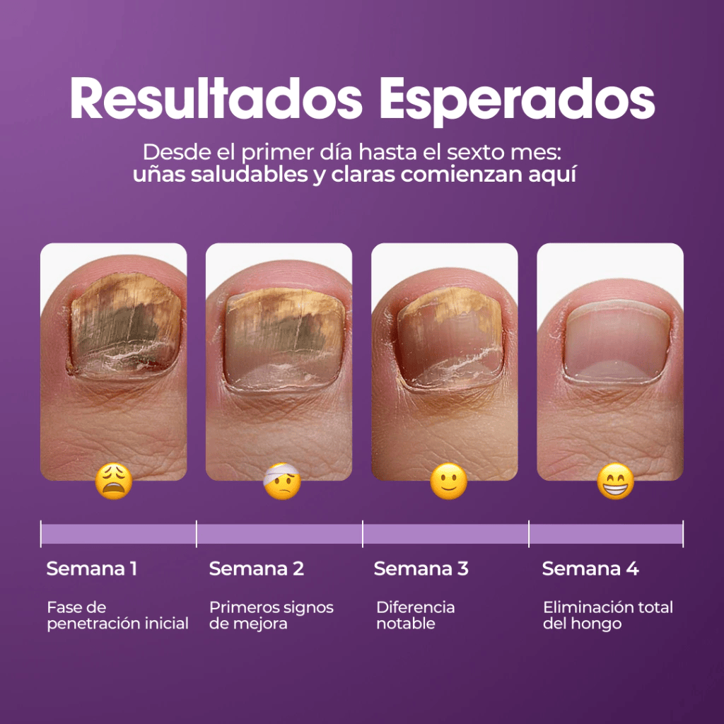 🌿¡Tratatamiento intensivo! Aureva Antihongos Pro Repair Oil Maxâ„¢  - Adiós a los hongos en solo 7 dÃas (Copy)