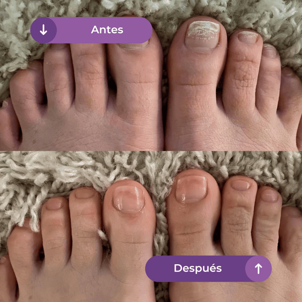 🌿¡Tratatamiento intensivo! Aureva Antihongos Pro Repair Oil Max™  - Adiós a los hongos en solo 7 días (Copy)